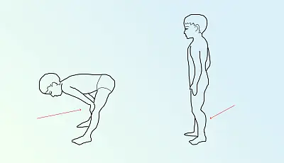 День осведомленности о мышечной дистрофии Дюшенна